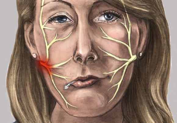 CAMBIOS BRUSCOS DE TEMPERATURA O BAJA DEL SISTEMA INMUNE ORIGINAN  PARÁLISIS FACIAL