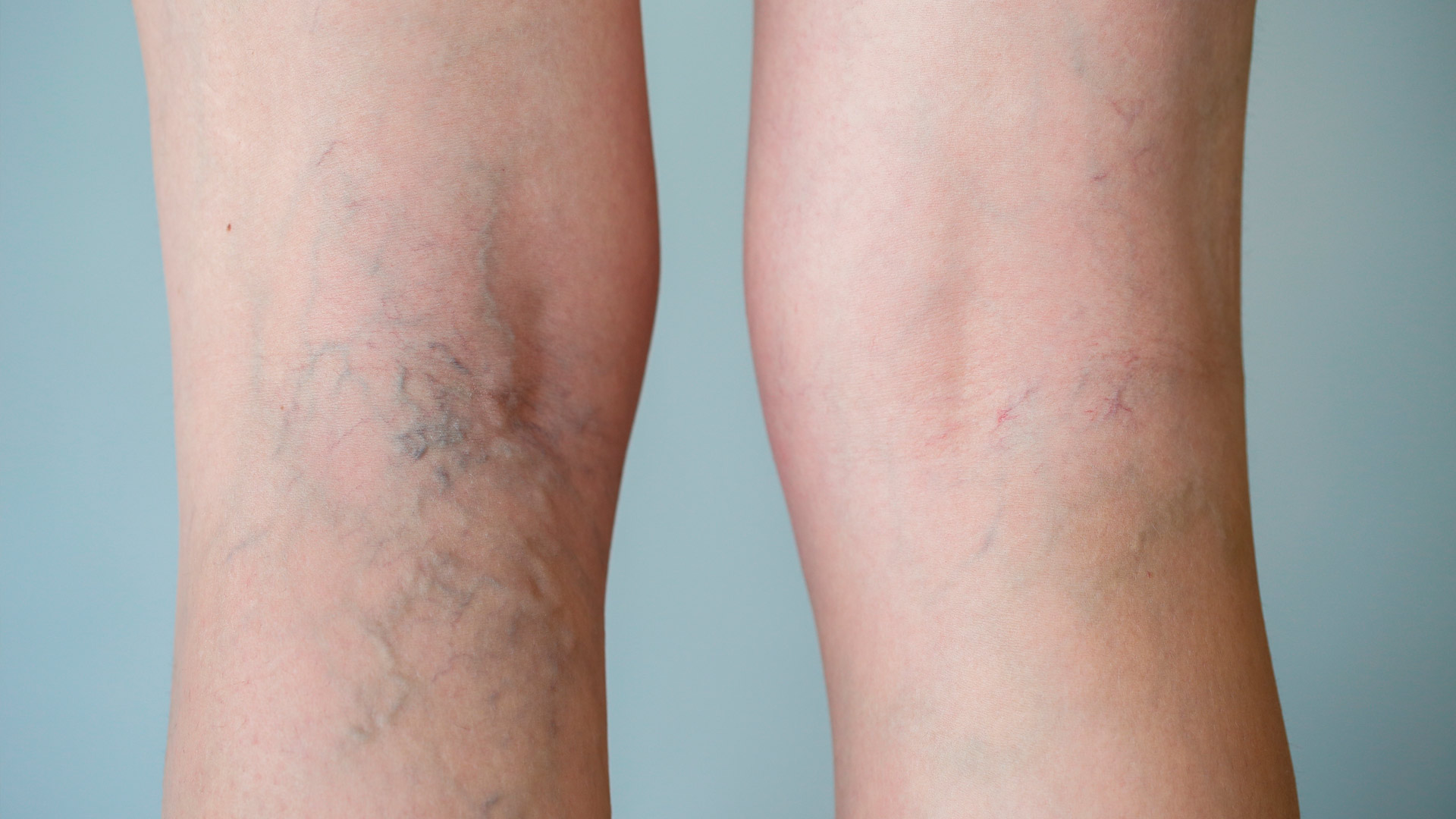 Trombosis venosa: síntomas y causas