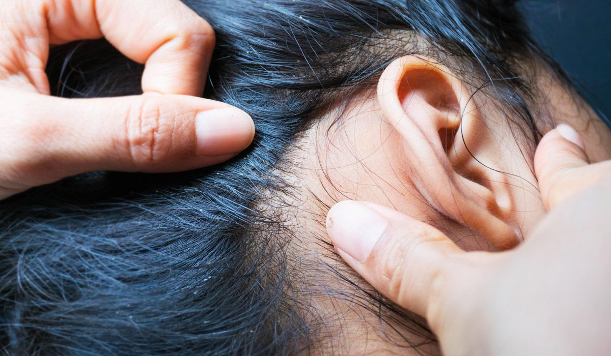 #TipsdeSalud 8 REMEDIOS CASEROS PARA ACABAR CON LOS INDESEABLES PIOJOS.