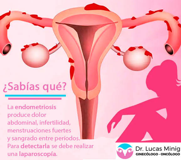 En México, una de cada 10 mujeres en edad reproductiva puede padecer endometriosis
