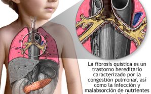 #Salud FIBROSIS QUÍSTICA: LA ENFERMEDAD GENÉTICA QUE AFECTA LOS PULMONES…